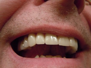 Nadwrażliwość zębów – jak jej uniknąć? 